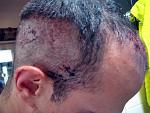 Day1 FUE Hair Transplant Dr Woods - After procedure from the side - look at donor and implant area