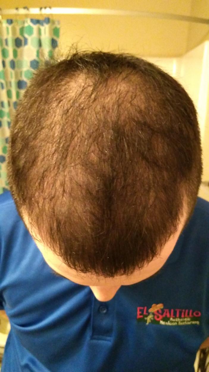 Click image for larger version

Name:	Before Treatment or FUE.jpg

Size:	91.8 KB
ID:	52731