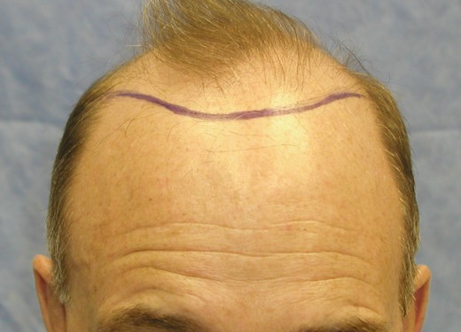 Click image for larger version

Name:	3_position_of_hairline.jpg

Size:	44.7 KB
ID:	36201