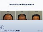 A patient as seen at different stages post transplant from Dr. Carlos K. Wesley