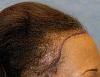 Click image for larger version

Name:	06_position-of-hairline-right-view.jpg

Size:	82.3 KB
ID:	9558
