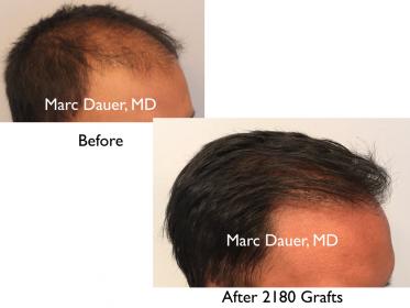 Click image for larger version

Name:	Hair Transplant Slides copy50.003.jpg

Size:	12.0 KB
ID:	45372