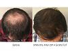 Patient hair transplant result of Dr. Marc Dauer.