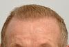 Click image for larger version

Name:	full-face-hairline-closeup-BT.jpg

Size:	91.6 KB
ID:	36641