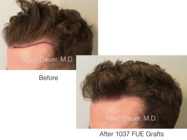 Click image for larger version

Name:	FUE hairline and eyebrow.001.jpg

Size:	11.8 KB
ID:	54213