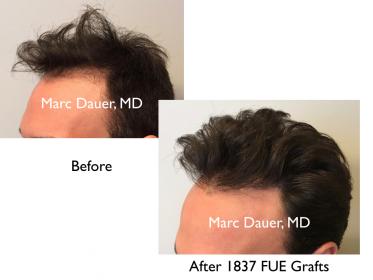 Click image for larger version

Name:	Hair Transplant Slides copy229.007.jpg

Size:	11.6 KB
ID:	49062