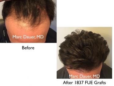 Click image for larger version

Name:	Hair Transplant Slides copy229.005.jpg

Size:	13.6 KB
ID:	49064