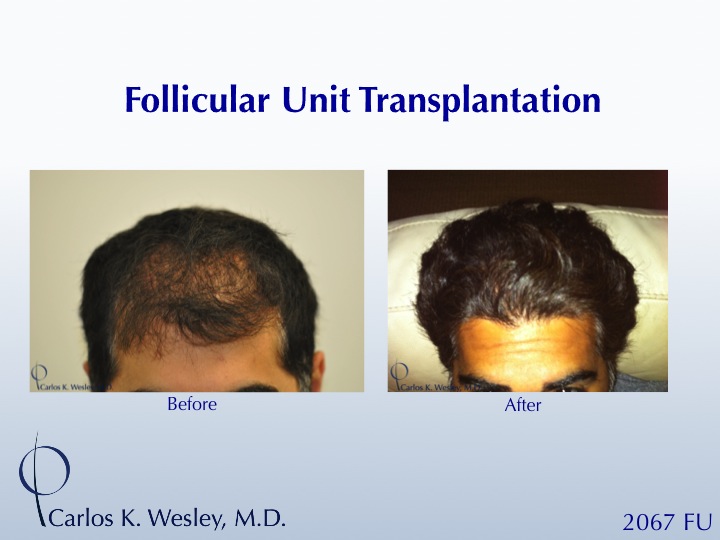 This patient had a session with Dr. Carlos K. Wesley (NYC) to increase the hair density throughout the frontal half of his scalp and improve the...