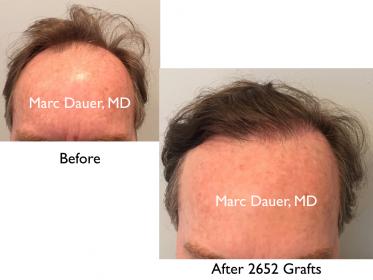 Click image for larger version

Name:	Hair Transplant Slides copy51.001.jpg

Size:	13.2 KB
ID:	46600