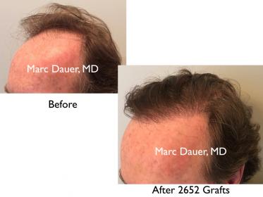 Click image for larger version

Name:	Hair Transplant Slides copy51.002.jpg

Size:	12.6 KB
ID:	46602