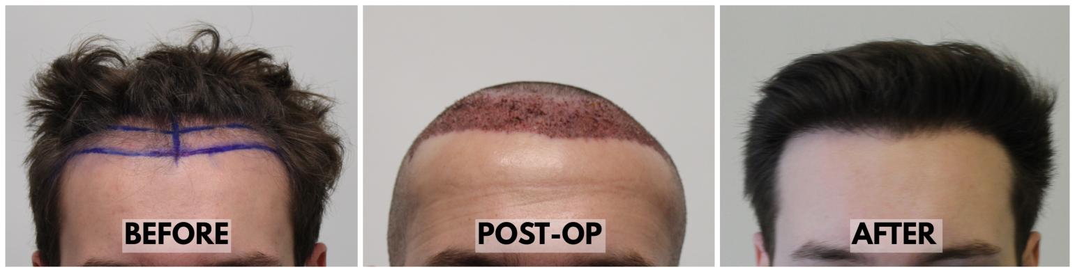 Click image for larger version  Name:	Hairline-Forum.jpg Views:	0 Size:	55.6 KB ID:	534340
