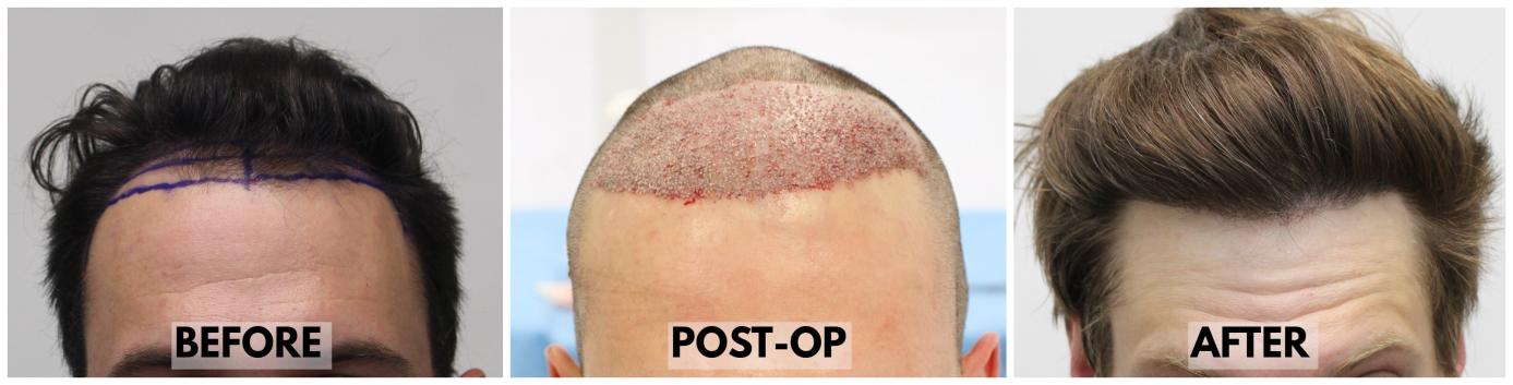 Click image for larger version

Name:	Hairline-Forum.jpg
Views:	68
Size:	60.5 KB
ID:	534599