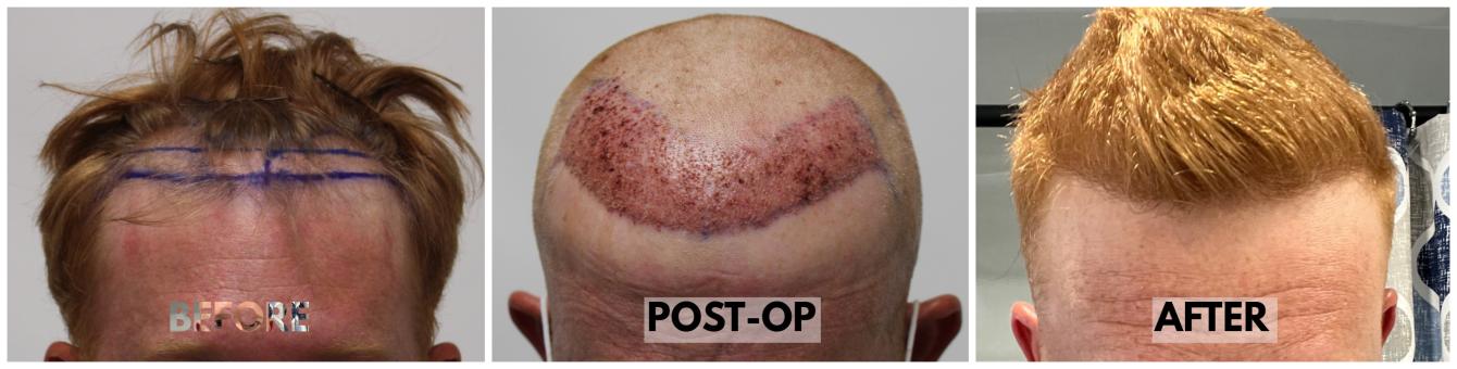 Click image for larger version

Name:	Hairline-Forum.jpg
Views:	115
Size:	66.6 KB
ID:	534788