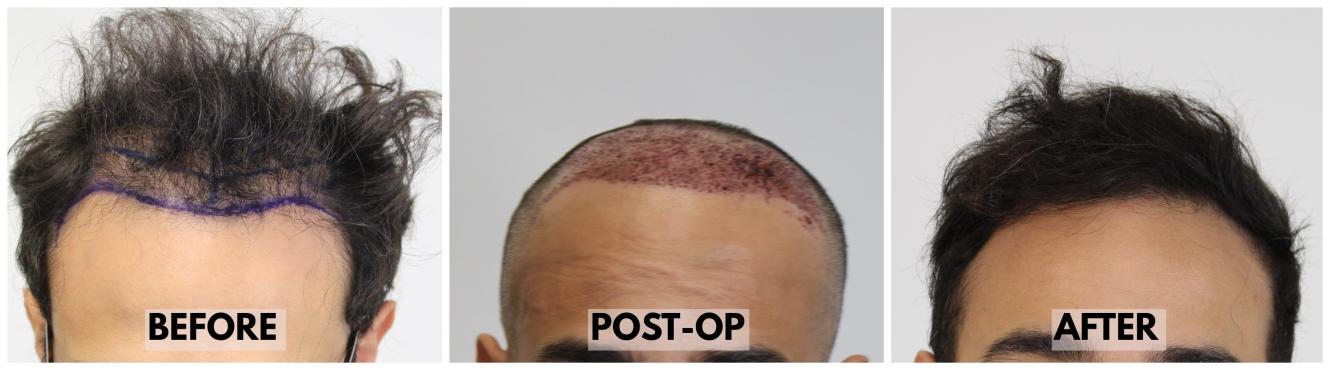 Click image for larger version

Name:	Hairline-Forum.jpg
Views:	120
Size:	57.4 KB
ID:	536186