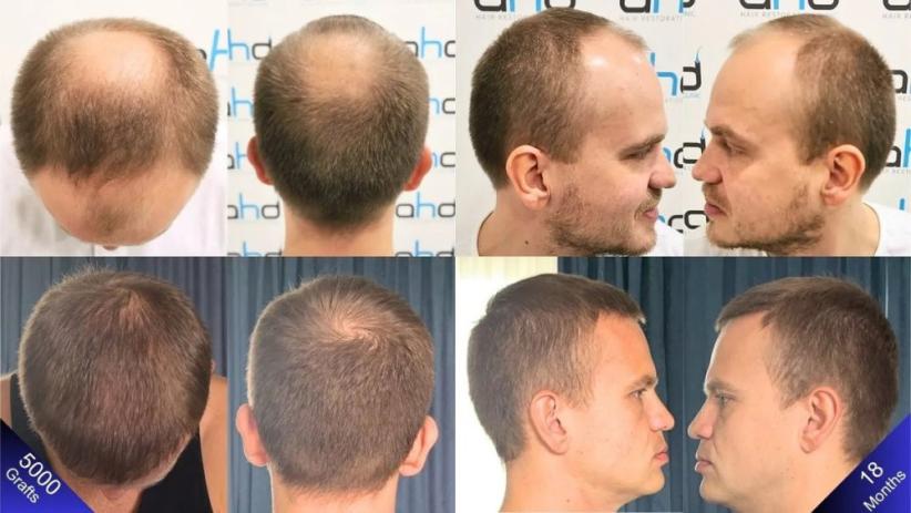 Click image for larger version  Name:	natural-hair-transplant-results.jpg Views:	0 Size:	53.9 KB ID:	540484