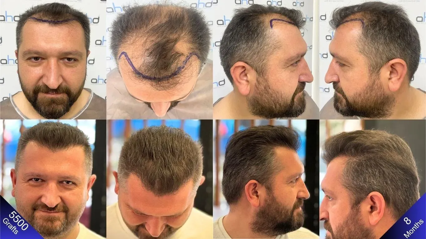 Click image for larger version

Name:	hair_transplant_result_turkey.webp
Views:	0
Size:	157.9 KB
ID:	540646