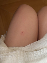 Click image for larger version  Name:	Kesimpta Injections.png Views:	0 Size:	45.9 KB ID:	541857