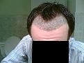 Click image for larger version

Name:	Post-op 9 days - wet.jpg
Views:	1852
Size:	33.4 KB
ID:	432161