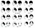 Click image for larger version

Name:	male-baldness.jpg
Views:	337
Size:	18.1 KB
ID:	432664