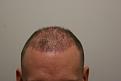 Click image for larger version

Name:	post op 3 weeks 1.jpg
Views:	704
Size:	95.0 KB
ID:	432776