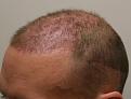 Click image for larger version

Name:	post op 3 weeks 2.jpg
Views:	729
Size:	41.6 KB
ID:	432777