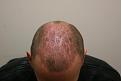 Click image for larger version

Name:	post op 3 weeks 4.jpg
Views:	618
Size:	25.3 KB
ID:	432779