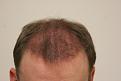 Click image for larger version

Name:	post op 3 months 1.jpg
Views:	674
Size:	28.9 KB
ID:	432938