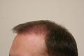 Click image for larger version

Name:	post op 3 months 2.jpg
Views:	680
Size:	22.9 KB
ID:	432939