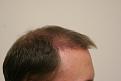 Click image for larger version

Name:	post op 3 months 3.jpg
Views:	633
Size:	25.9 KB
ID:	432940