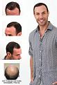 Click image for larger version

Name:	jason-hair-transplant.jpg
Views:	3885
Size:	63.6 KB
ID:	432944