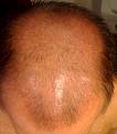 Click image for larger version

Name:	Top - 2.5 weeks post op - 2 - Copy.jpg
Views:	676
Size:	60.9 KB
ID:	433003