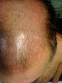 Click image for larger version

Name:	Top - 2.5 weeks post op - 3.jpg
Views:	713
Size:	39.7 KB
ID:	433004