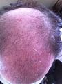 Click image for larger version

Name:	May 17 2 months post op.jpg
Views:	698
Size:	96.6 KB
ID:	433213
