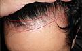 Click image for larger version

Name:	Post op hairilne - 9 months.JPG
Views:	704
Size:	64.3 KB
ID:	433507