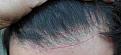 Click image for larger version

Name:	11 months post-op.JPG
Views:	734
Size:	42.7 KB
ID:	433698