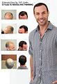 Click image for larger version

Name:	jason-hair-transplant.jpg
Views:	327
Size:	66.6 KB
ID:	433782
