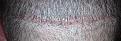 Click image for larger version

Name:	21 day lower scar.jpg
Views:	1422
Size:	113.0 KB
ID:	434295