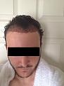 Click image for larger version

Name:	1 Day Post Op 2.jpg
Views:	1328
Size:	96.5 KB
ID:	434445