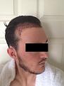 Click image for larger version

Name:	1 Day Post Op 4.jpg
Views:	1553
Size:	96.0 KB
ID:	434447