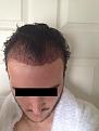 Click image for larger version

Name:	1 Day Post Op.jpg
Views:	1344
Size:	96.8 KB
ID:	434449