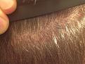 Click image for larger version

Name:	upper scar rt side 130 days.jpg
Views:	1139
Size:	94.2 KB
ID:	434692