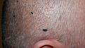 Click image for larger version

Name:	Right-Ear-View-Day-4.jpg
Views:	525
Size:	99.1 KB
ID:	434840