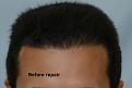 Click image for larger version

Name:	LowHairlineRepair.jpg
Views:	424
Size:	80.1 KB
ID:	436205