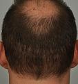 Click image for larger version

Name:	#4 guard 9 months 1st procedure.jpg
Views:	986
Size:	96.2 KB
ID:	436248