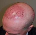 Click image for larger version

Name:	Afterimplant3.jpg
Views:	484
Size:	93.2 KB
ID:	436487