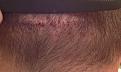 Click image for larger version

Name:	3 days post lower scar.jpg
Views:	925
Size:	85.7 KB
ID:	436574
