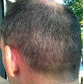 Click image for larger version

Name:	lt side 3mo second procedure.jpg
Views:	655
Size:	33.3 KB
ID:	436938