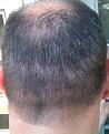 Click image for larger version

Name:	back 3mo second procedure.JPG
Views:	680
Size:	83.2 KB
ID:	436939