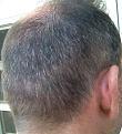 Click image for larger version

Name:	rt side 3mo second procedure.JPG
Views:	695
Size:	82.4 KB
ID:	436940