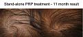 Click image for larger version

Name:	ACell-PRP-Stand-Alone-closeup.jpg
Views:	570
Size:	97.7 KB
ID:	436977